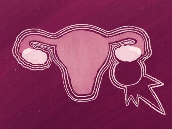 Ovarian Cysts: Causes, Symptoms, Diagnosis & Treatment